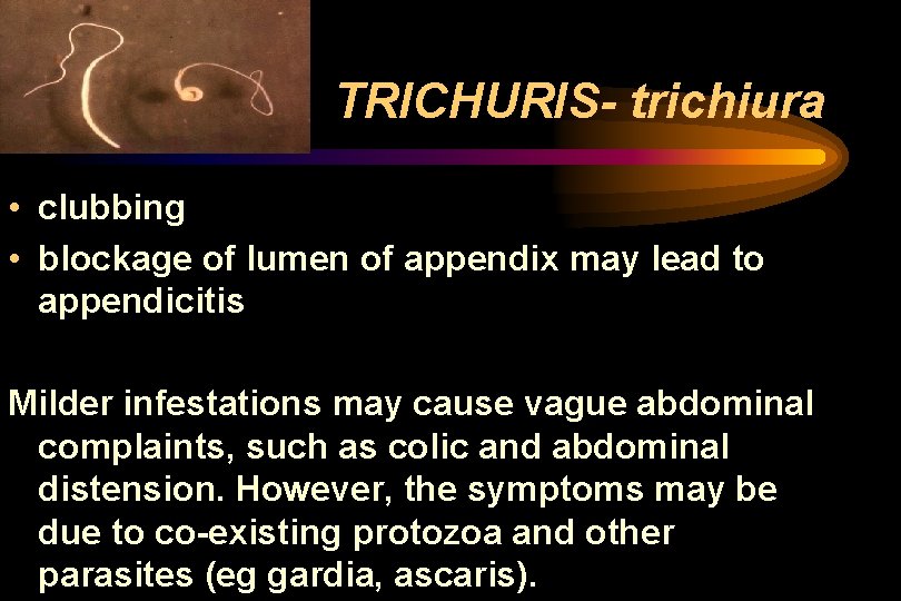TRICHURIS- trichiura • clubbing • blockage of lumen of appendix may lead to appendicitis TRICHURIS- trichiura • clubbing • blockage of lumen of appendix may lead to appendicitis