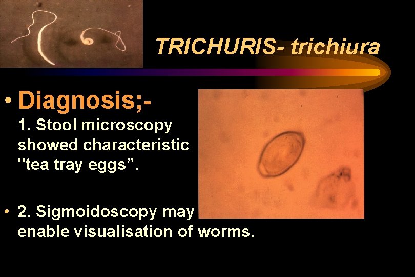 TRICHURIS- trichiura • Diagnosis; 1. Stool microscopy showed characteristic "tea tray eggs”. • 2. TRICHURIS- trichiura • Diagnosis; 1. Stool microscopy showed characteristic "tea tray eggs”. • 2.