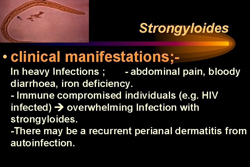 Strongyloides • clinical manifestations; In heavy Infections ; - abdominal pain, bloody diarrhoea, iron Strongyloides • clinical manifestations; In heavy Infections ; - abdominal pain, bloody diarrhoea, iron