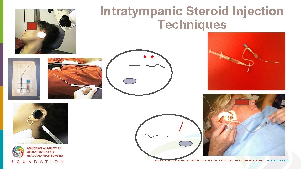 Intratympanic Steroid Injection Techniques THE GLOBAL LEADER IN OPTIMIZING QUALITY EAR, NOSE, AND THROAT Intratympanic Steroid Injection Techniques THE GLOBAL LEADER IN OPTIMIZING QUALITY EAR, NOSE, AND THROAT