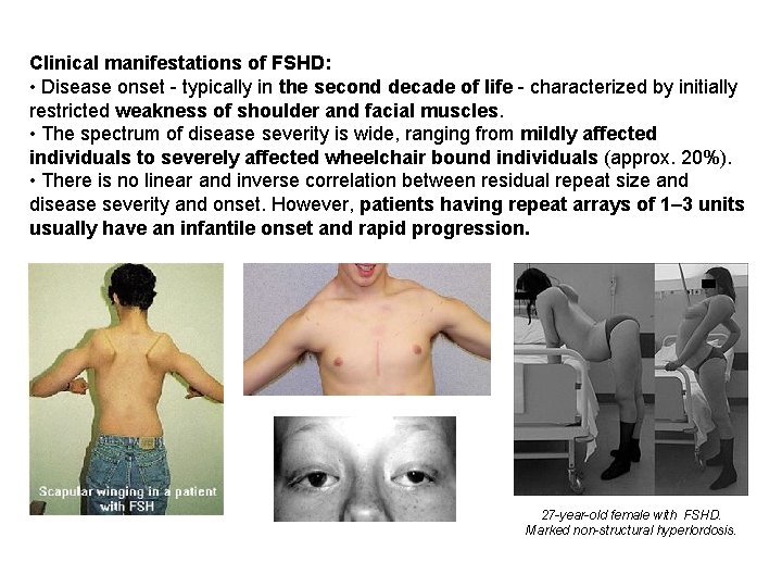 Clinical manifestations of FSHD: • Disease onset - typically in the second decade of