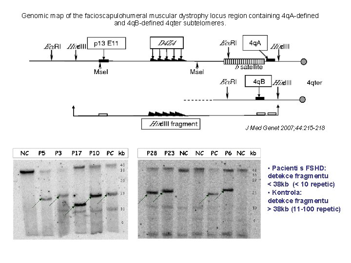 Genomic map of the facioscapulohumeral muscular dystrophy locus region containing 4 q. A-defined and