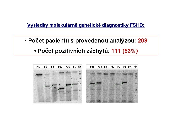 Výsledky molekulárně genetické diagnostiky FSHD: • Počet pacientů s provedenou analýzou: 209 • Počet