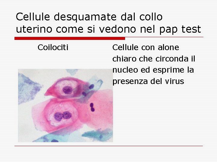 Cellule desquamate dal collo uterino come si vedono nel pap test Coilociti Cellule con
