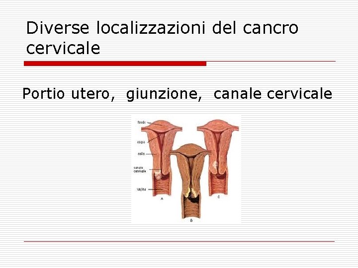 Diverse localizzazioni del cancro cervicale Portio utero, giunzione, canale cervicale 