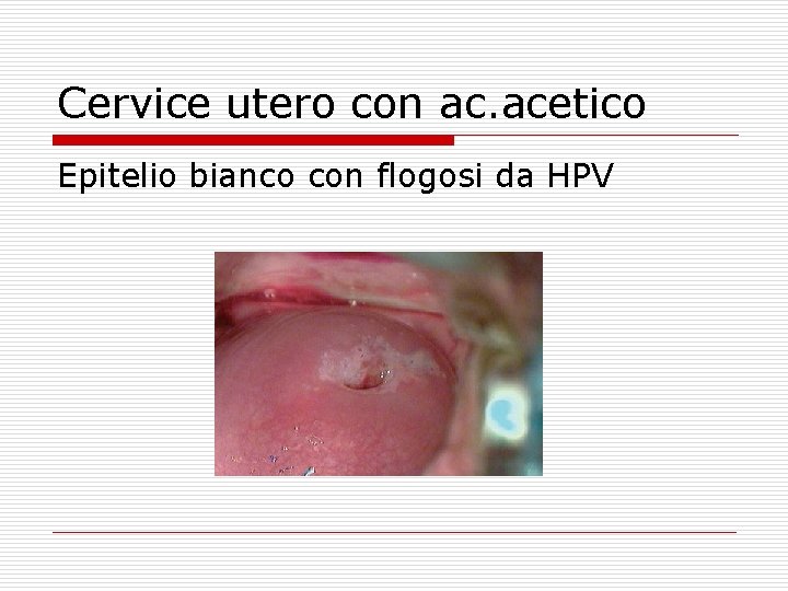 Cervice utero con ac. acetico Epitelio bianco con flogosi da HPV 