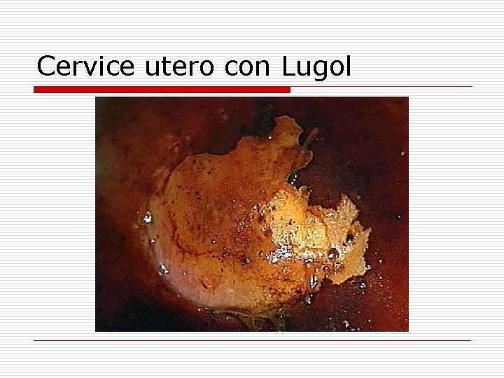 Cervice utero con Lugol 