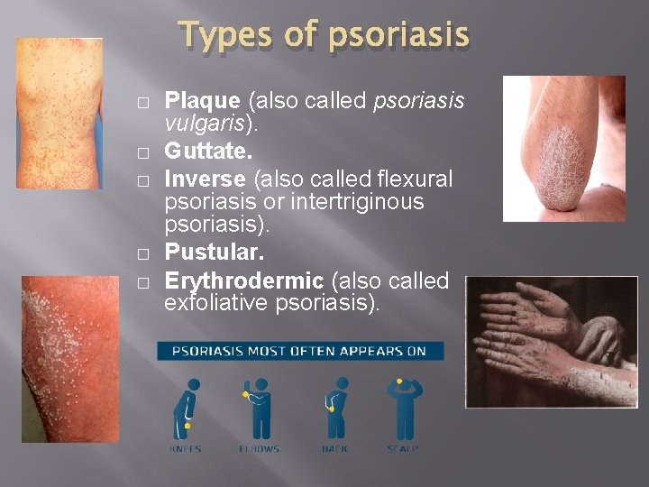 Types of psoriasis � � � Plaque (also called psoriasis vulgaris). Guttate. Inverse (also