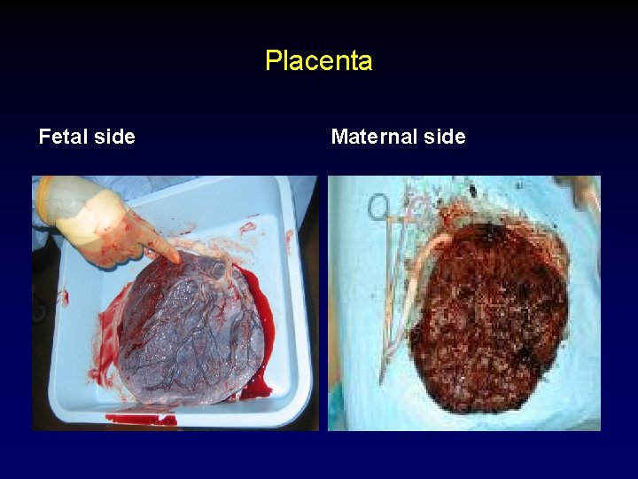 Placenta Fetal side Maternal side 