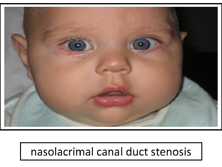 nasolacrimal canal duct stenosis 