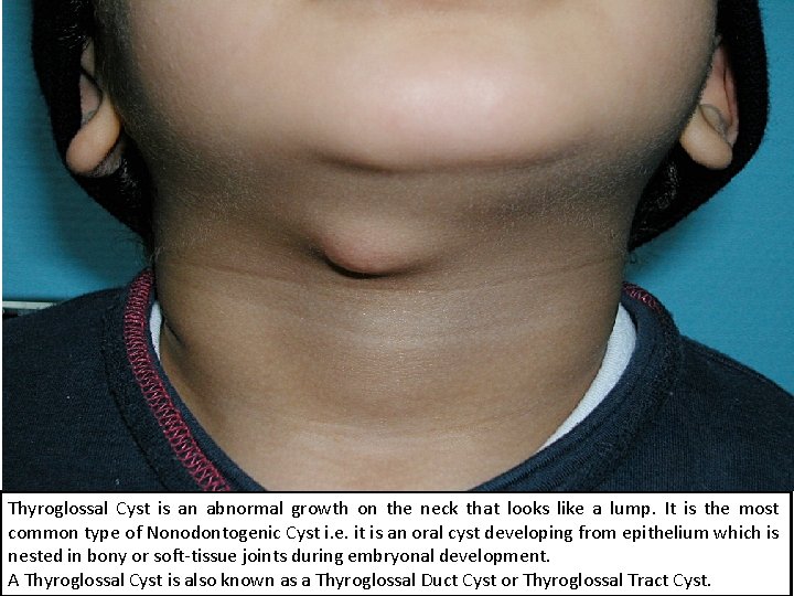 Thyroglossal Cyst is an abnormal growth on the neck that looks like a lump.