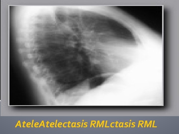 Atelectasis RML 