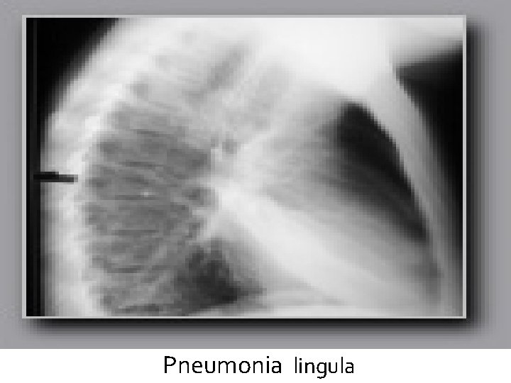 Pneumonia lingula 
