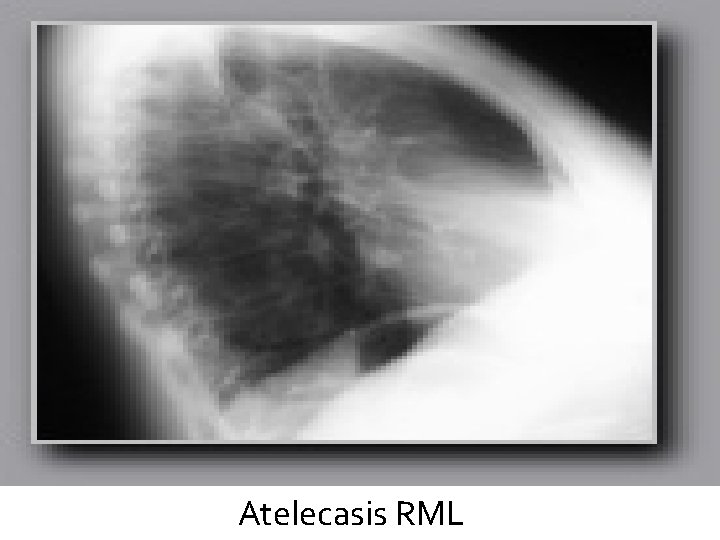 Atelecasis RML 