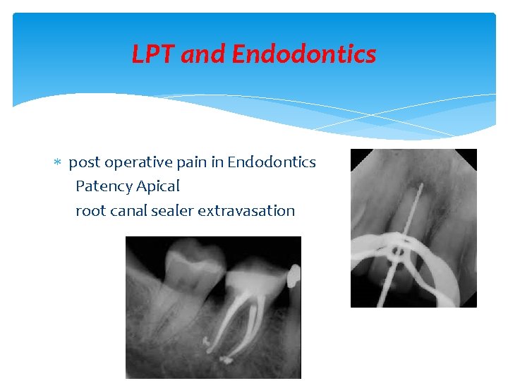 LPT and Endodontics post operative pain in Endodontics Patency Apical root canal sealer extravasation
