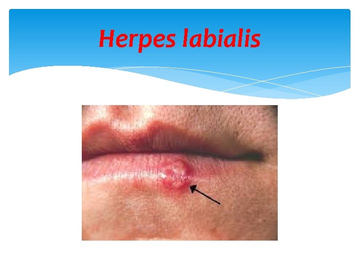 Herpes labialis 