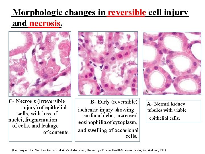 Morphologic changes in reversible cell injury and necrosis. C- Necrosis (irreversible injury) of epithelial