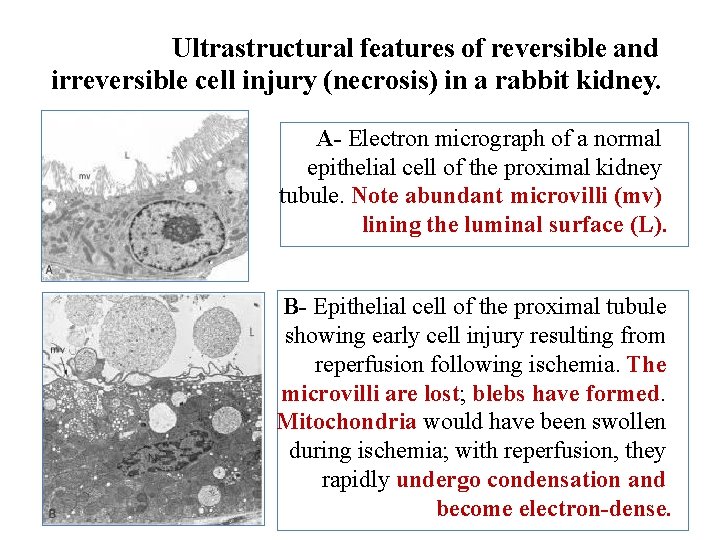 Ultrastructural features of reversible and irreversible cell injury (necrosis) in a rabbit kidney. A-