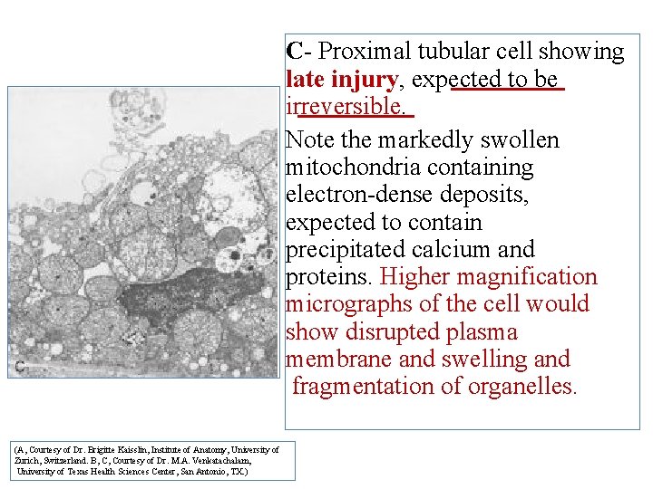 C- Proximal tubular cell showing late injury, expected to be irreversible. Note the markedly