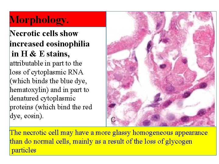 Morphology. Necrotic cells show increased eosinophilia in H & E stains, attributable in part