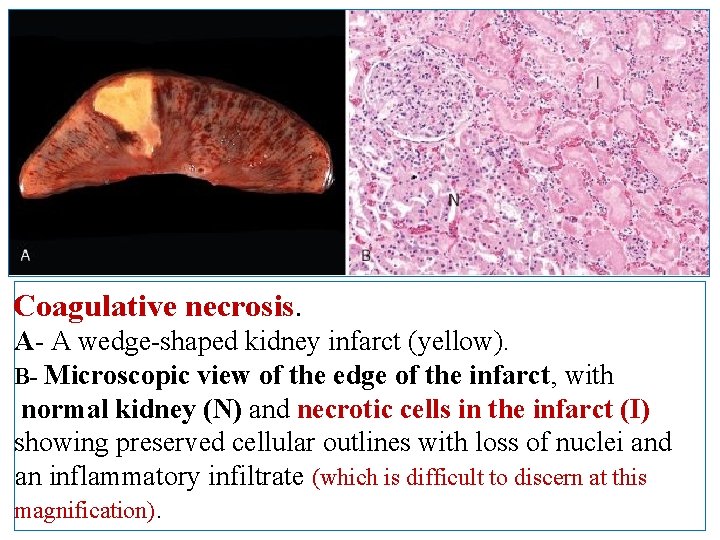 Coagulative necrosis. A- A wedge-shaped kidney infarct (yellow). B- Microscopic view of the edge