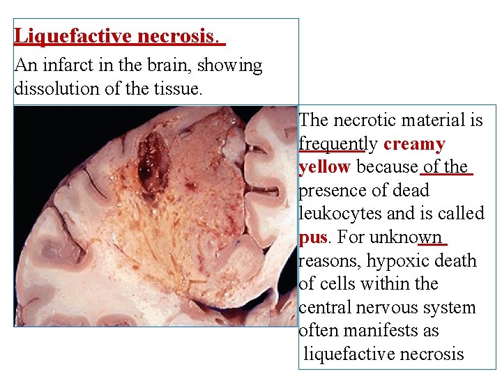 Liquefactive necrosis. An infarct in the brain, showing dissolution of the tissue. The necrotic