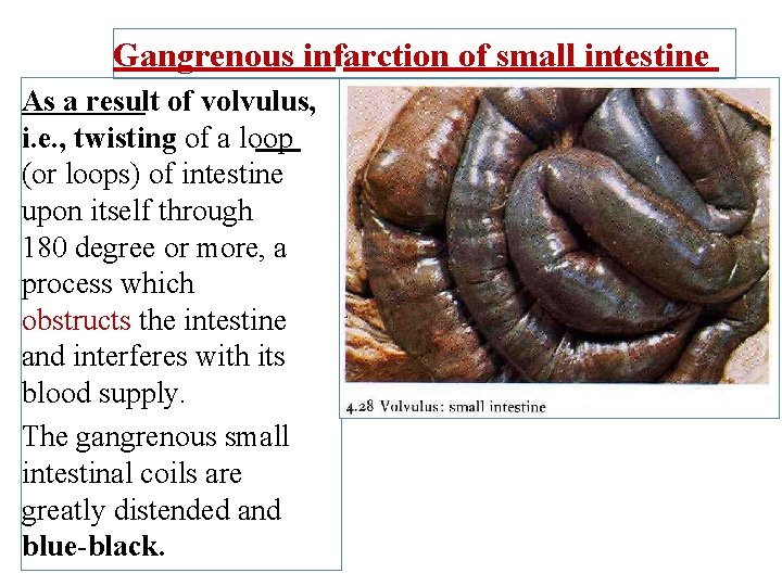 Gangrenous infarction of small intestine As a result of volvulus, i. e. , twisting