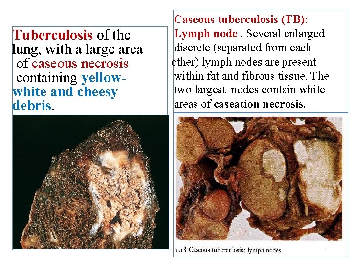 Tuberculosis of the lung, with a large area of caseous necrosis containing yellowwhite and