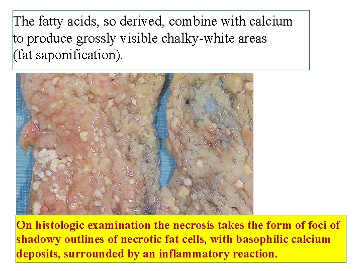 The fatty acids, so derived, combine with calcium to produce grossly visible chalky-white areas