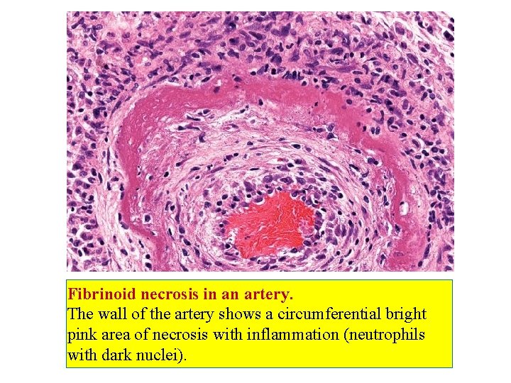 Fibrinoid necrosis in an artery. The wall of the artery shows a circumferential bright