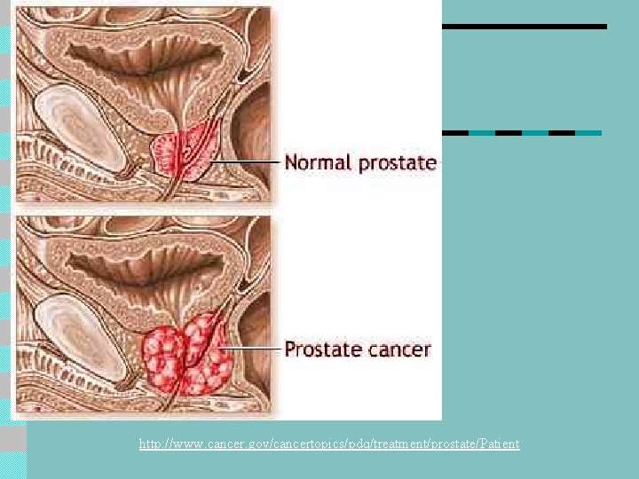 http: //www. cancer. gov/cancertopics/pdq/treatment/prostate/Patient 