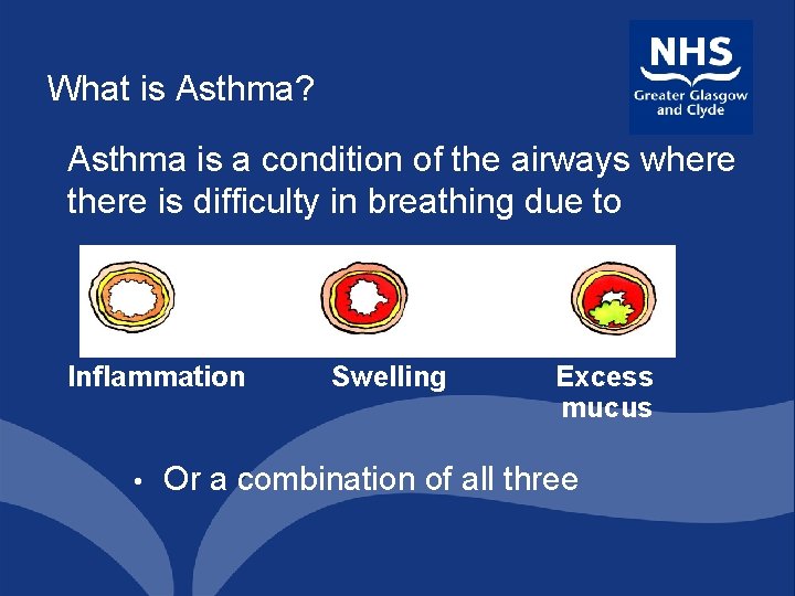 What is Asthma? Asthma is a condition of the airways where there is difficulty
