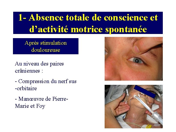 1 - Absence totale de conscience et d’activité motrice spontanée Après stimulation douloureuse Au