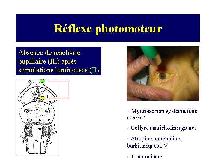 Réflexe photomoteur Absence de réactivité pupillaire (III) après stimulations lumineuses (II) - Mydriase non