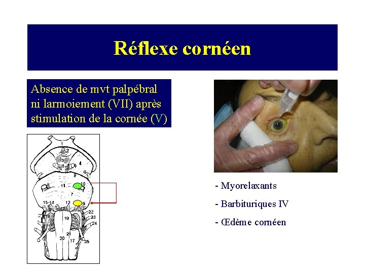 Réflexe cornéen Absence de mvt palpébral ni larmoiement (VII) après stimulation de la cornée