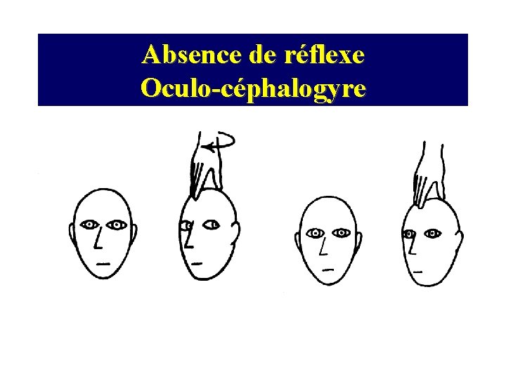 Absence de réflexe Oculo-céphalogyre Réflexe présent Réflexe absent 