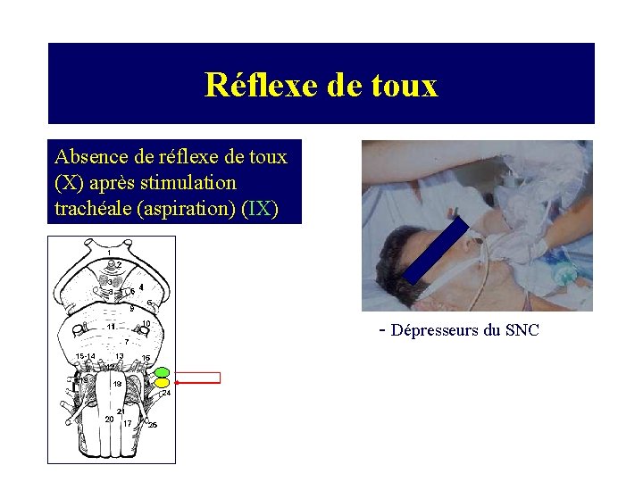 Réflexe de toux Absence de réflexe de toux (X) après stimulation trachéale (aspiration) (IX)