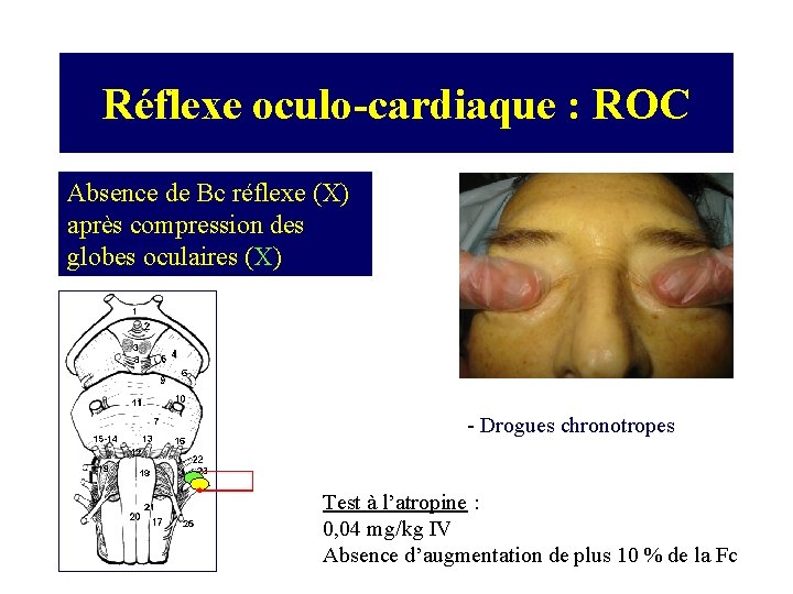 Réflexe oculo-cardiaque : ROC Absence de Bc réflexe (X) après compression des globes oculaires