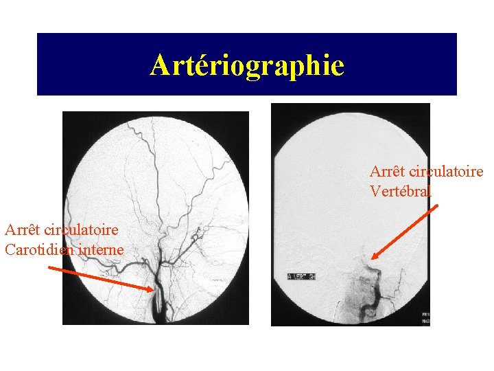Artériographie Arrêt circulatoire Vertébral Arrêt circulatoire Carotidien interne 