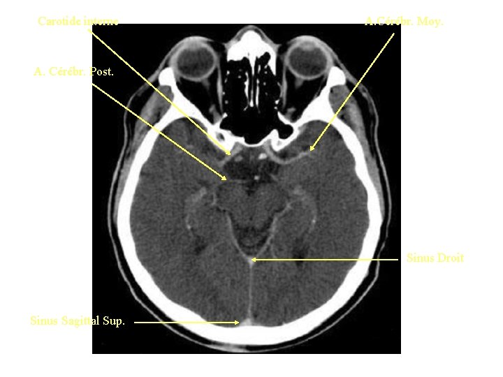 Carotide interne A. Cérébr. Moy. A. Cérébr. Post. Sinus Droit Sinus Sagittal Sup. 