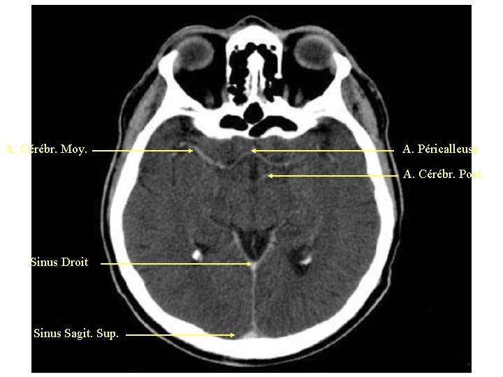 A. Cérébr. Moy. A. Péricalleuse A. Cérébr. Post. Sinus Droit Sinus Sagit. Sup. 