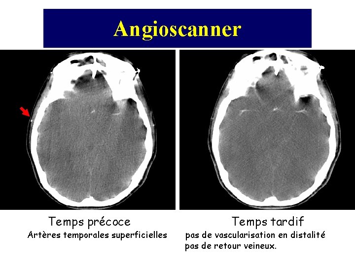 Angioscanner Temps précoce Artères temporales superficielles Temps tardif pas de vascularisation en distalité pas