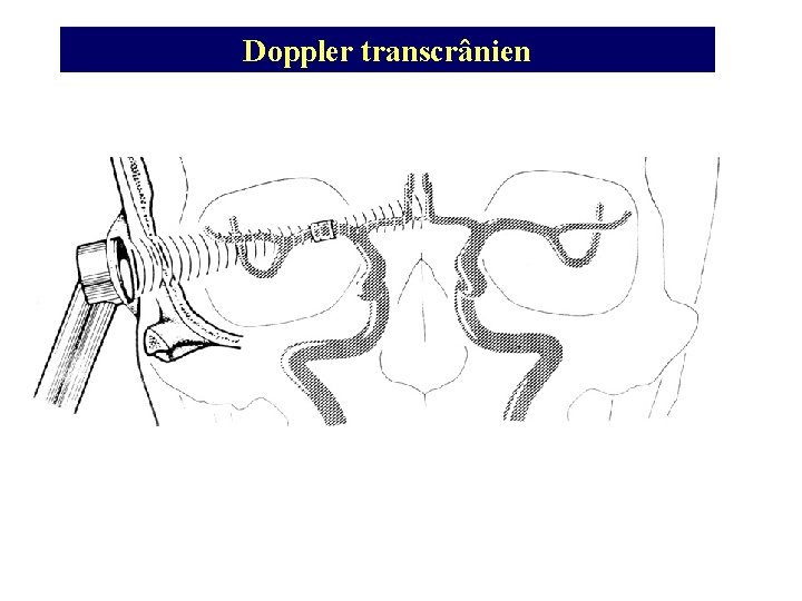 Doppler transcrânien 