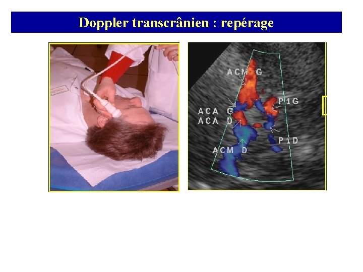 Doppler transcrânien : repérage 