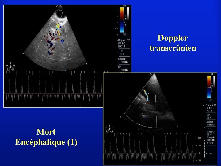 Doppler transcrânien Mort Encéphalique (1) 