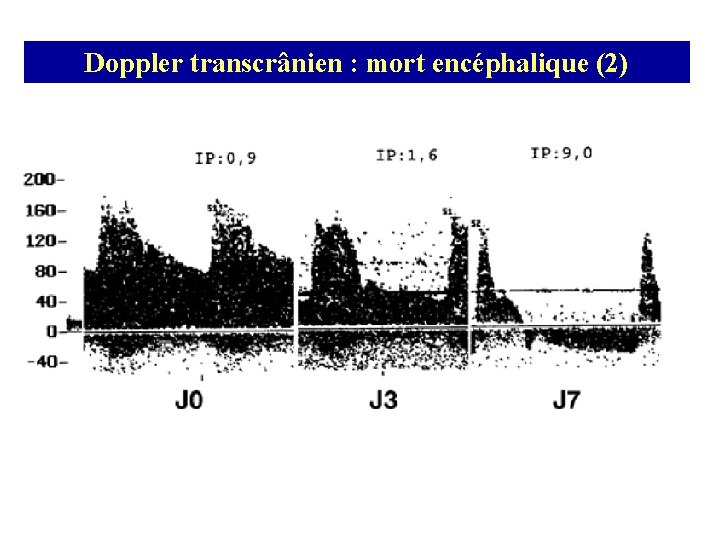 Doppler transcrânien : mort encéphalique (2) 