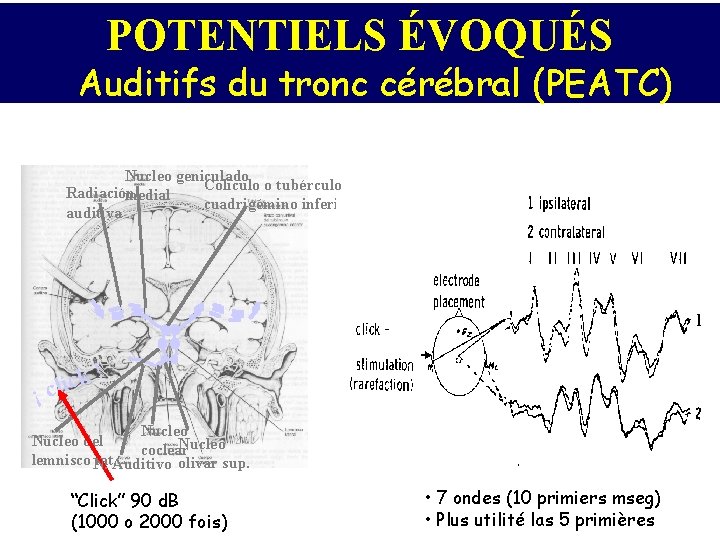 POTENTIELS ÉVOQUÉS Auditifs du tronc cérébral (PEATC) Ils étudient la voie auditive depuis le