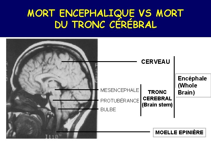 MORT ENCEPHALIQUE VS MORT DU TRONC CÉRÉBRAL CERVEAU MESENCEPHALE TRONC PROTUBÉRANCE CEREBRAL (Brain stem)