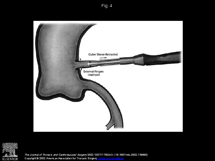Fig. 4 The Journal of Thoracic and Cardiovascular Surgery 2002 123777 -782 DOI: (10.