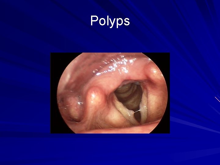 Polyps 